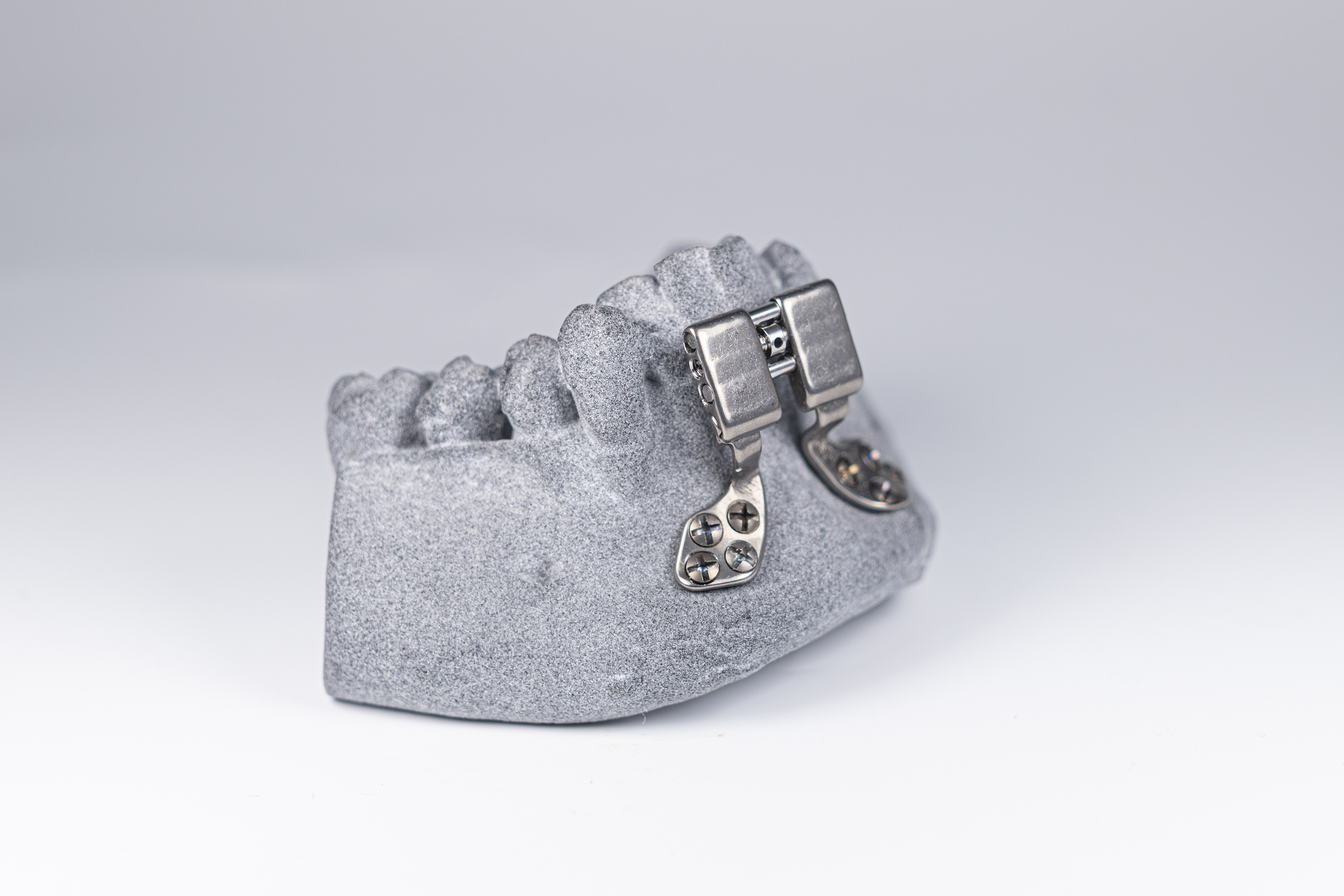 Kieferorthopädische Distraktoren werden heute als Standardteil gefertigt und erst im Operationsprozess angepasst: Langwierig und unangenehm für den Patienten. Die additive Fertigung soll die Vorlaufzeiten verkürzen und eine individuellere Anpassung an den Patienten ermöglichen.